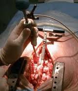 lumbarsurgery