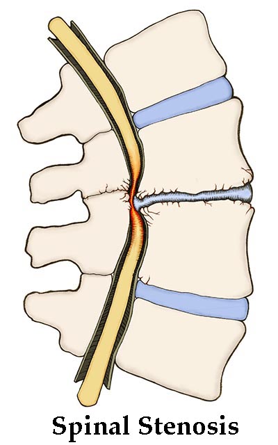 Spinal-stenosis 400x640